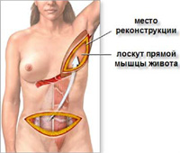 кожно-мышечный лоскут с нижнебоковой части спины (Rubens flap)