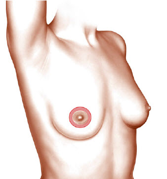уменьшение ареолы- периареолярная подтяжка груди