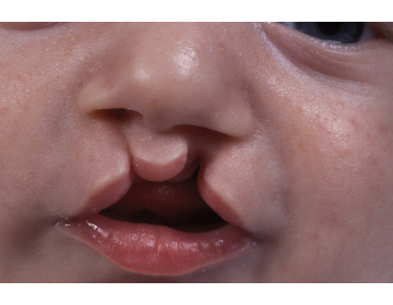 Расщелина губы и неба у детей: причины и особенности заболевания, хирургическое решение
