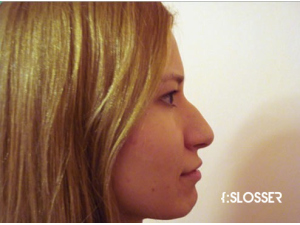 Восстановление эстетических пропорций носа - Фото 1