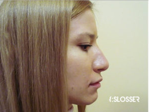 Восстановление эстетических пропорций носа - Фото 1