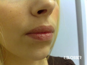 Отличный результат увеличения губ хирургическим методом- фото пациентки - Фото 1