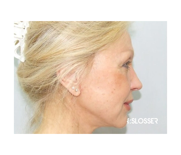 Подтяжка лица  SMAS техника и увеличение губ