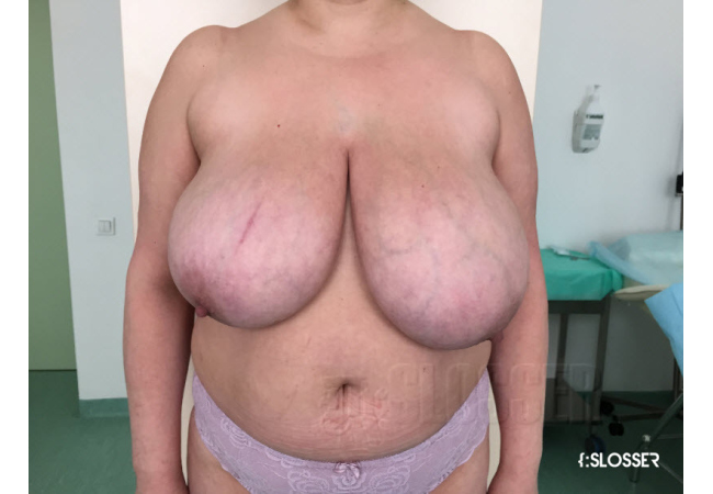 Уменьшение груди по Robbins - Фото 2