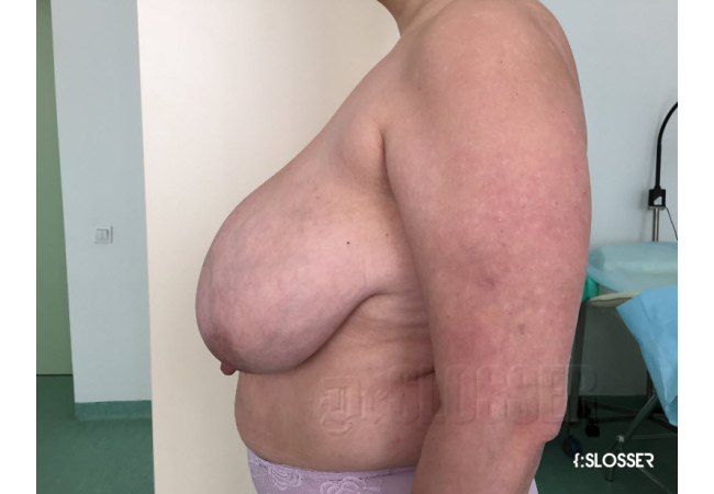 Уменьшение груди по Robbins - Фото 10