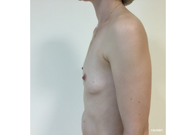 Увеличение груди при микромастии - Фото 4